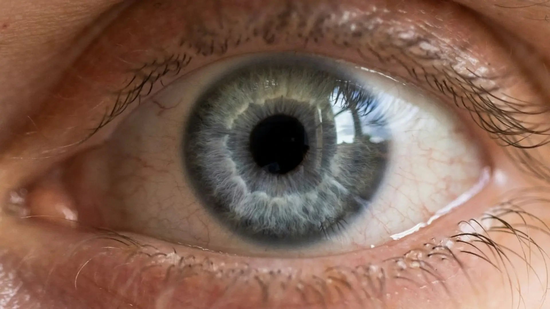 Los médicos descubren un clavo de 35 milímetros dentro del ojo de un hombre que había perdido la visión