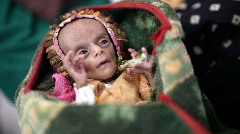 "Solo piel y huesos": los gemelos recién nacidos que tratan de sobrevivir a la guerra y el hambre en Yemen