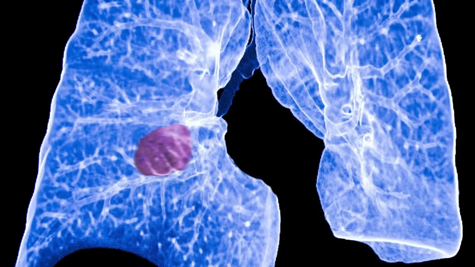 La IA encuentra pistas del riesgo de cáncer en los análisis de sangre que ya nos hacemos